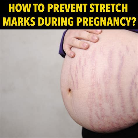 How To Prevent Pregnancy Stretch Marks Stretch Marks How To