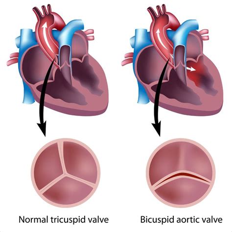 Bicuspid Aortic Valve Cardiology Highland Hospital University Of Rochester Medical Center