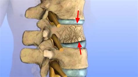 Compression Fracture Spine Causes Symptoms Diagnosis Treatment