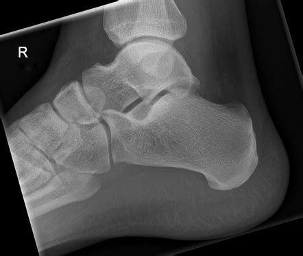 Calcaneus Lateral View Radiology Reference Article My Xxx Hot Girl