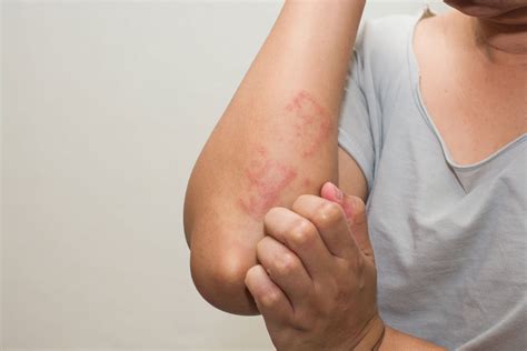 Eczema Atopic Dermatitis Inflamed Skin