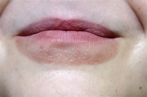 Lip Smacking Dermatitis Stock Image C0166876 Science Photo Library