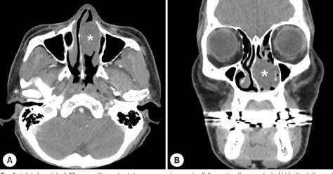 Figure 2 From A Case Of Myoepithelioma Involving Nasal Septum