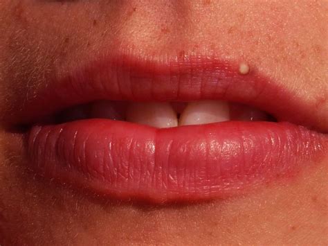 A Pimple On Lip Causes And Remedies Sjogrens Syndrome