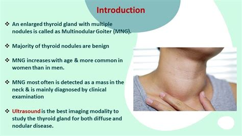 Euthyroid Multinodular Goitre Curofy Expert Clinical Case Discussion