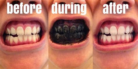 Once you do veneers, you're married to. Benefits of Activated Charcoal: Whiten Your Teeth, Detox ...