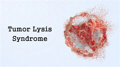 Tumor Lysis Syndrome Oncologic Emergencies Youtube