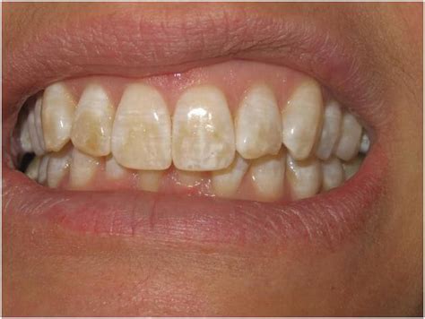 Reasons For Tooth Discoloration News Dentagama