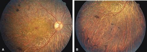 Degeneration And Atrophy Of The Choroid Ento Key