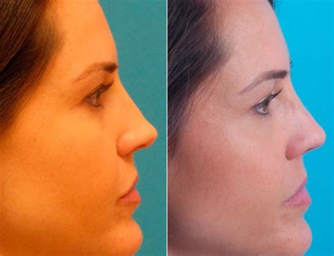 Twisted Nose Before And After Photos Becker Rhinoplasty Center