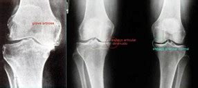 Guia da artrose do joelho Clínica Geral Doutíssima