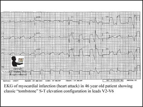 Myocardial Infarction Ekg Blog Trial Image Inc