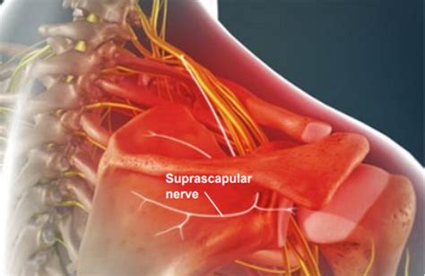 Suprascapular Neuropathy Nerve Pain Specialist In Texas