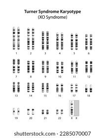 Turner Syndrome X0 Human Karyotype Stock Illustration 2285070007