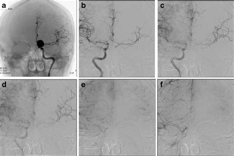 A Woman With A Giant Paraclinoid Aneurysm A Preoperative Left Internal