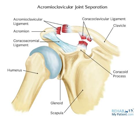 Acromioclavicular Joint Separation Rehab My Patient