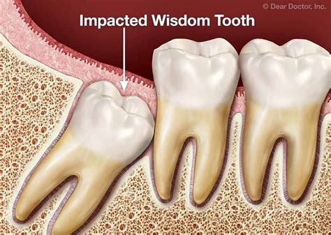 Normal Wisdom Tooth Extraction