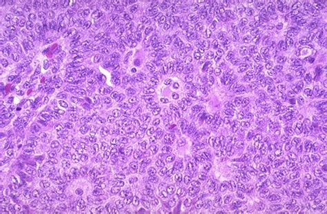 Granulosa Cell Tumor Pathology
