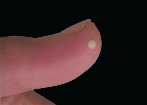Acceptable Animé Norme White Spot On Finger Tip Gouvernement Reine Peigne