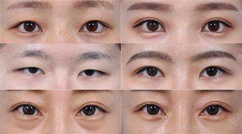 Korean Double Eyelids Surgery Guide To Different Surgical Methods Eunogo