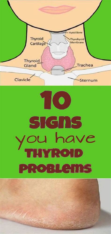 10 Important Signs You Have Thyroid Problems Health Activities