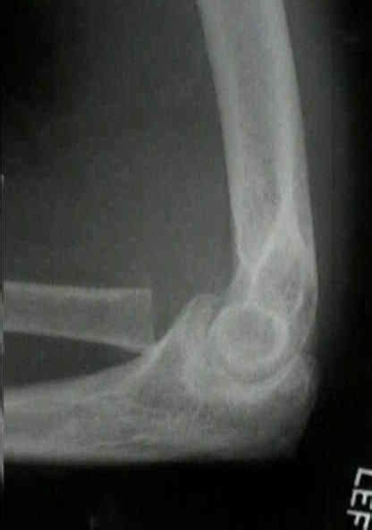 Excision Of Radial Head Wheeless Textbook Of Orthopaedics