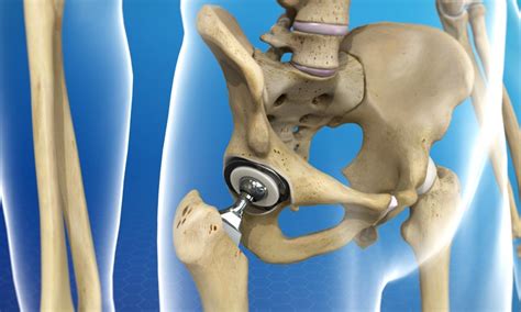 The Many Benefits Of Hip Replacement Surgery Brandon Orthopedics