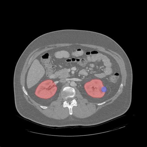 Computed Tomography Scans Of Kidney Tumors From The Kidney Tumor