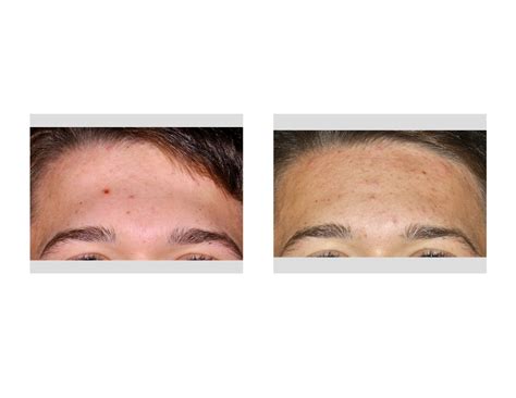 Forehead Recontouring Archives