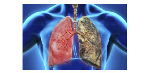 Epoc Enfermedad Pulmonar Obstructiva Crónica Síntomas Causas Y