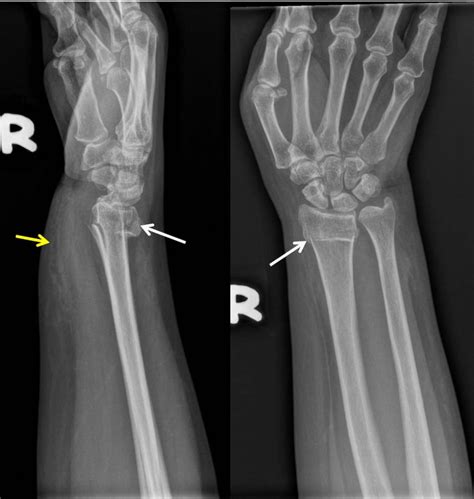 Colles Fracture Radiology Cases