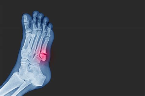 Złamany Palec U Nogi Jak Wygląda Leczenie Novum Ortopedia