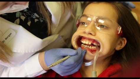 Painless extraction how to remove your wisdom tooth. How braces are put on your teeth. Full procedure. Easy ...