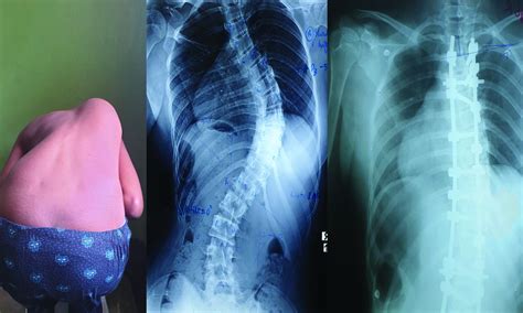 Paediatric Orthopaedic Spine Surgery Lady Ridgeway Hospital For Children