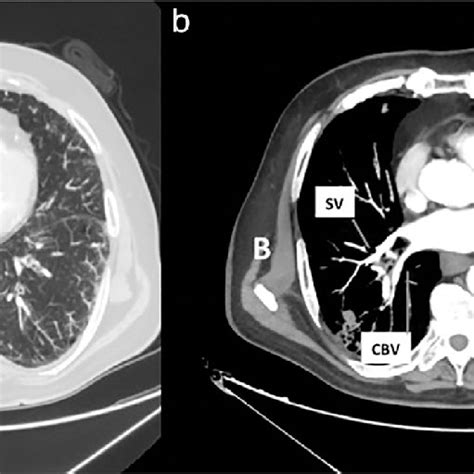 Chest Ct Scans With Maximum Intensity Projection Mip Reconstructions