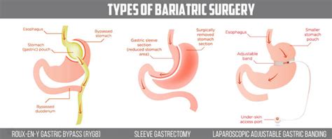 Types Of Bariatric Surgery Accelr8 Rehab