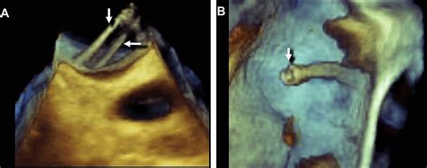 Artifacts In Three Dimensional Transesophageal Echocardiography