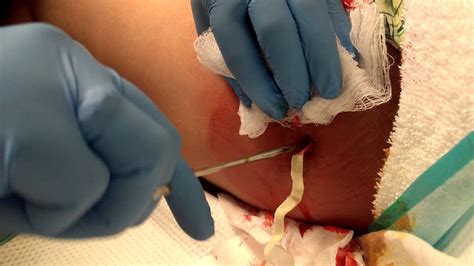Boils can occur on any part of the body. Incision & Drainage of an Infected Thigh Cyst - Part 2 ...