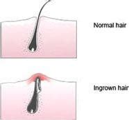 Ingrown hair and genital warts though similar to each other in appearance, greatly differ in all other aspects. What is the difference between an ingrown hair and a wart ...