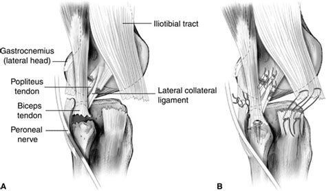 Plc Injury Posterolateral Corner Plc Tear And Reconstruction Knee