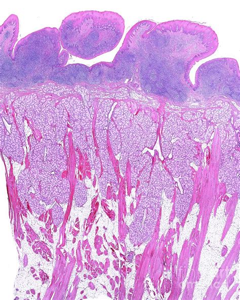Lingual Tonsil Photograph By Jose Calvo Science Photo Library Pixels
