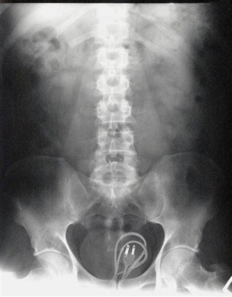 Buzz Lightyear And Mobile Phones Xrays Of Odd Objects Used In Sex