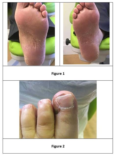 Hand And Foot Syndrome A Common Side Effect Of Chemotherapy