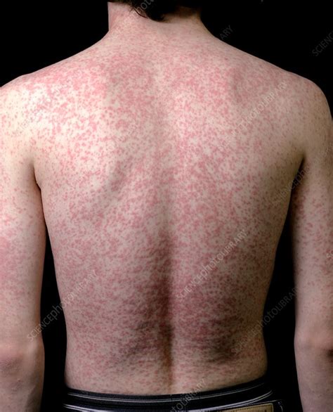 Body Rash Caused By Antibiotic Drug Stock Image C0156133 Science