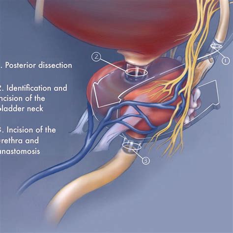 Retzius Sparing Radical Prostatectomy Key Steps Download Scientific Diagram