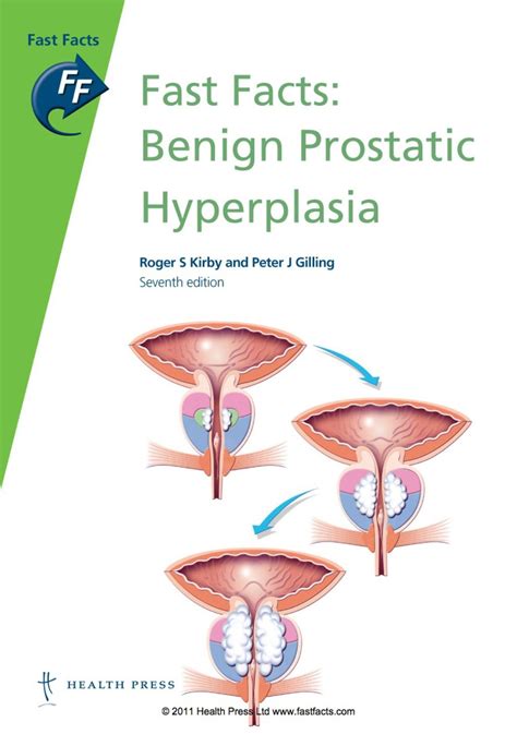 Fast Facts Benign Prostatic Hyperplasia Th Edition Ebook In Fast Facts Benign