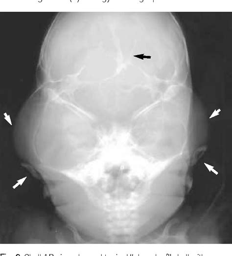 Figure 2 From The First Korean Case Of Beare Stevenson Syndrome With A