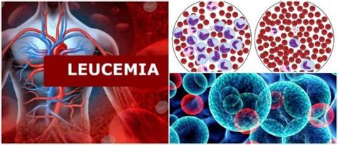 Check spelling or type a new query. Cannabis medicinal y su potencial para tratar la leucemia ...