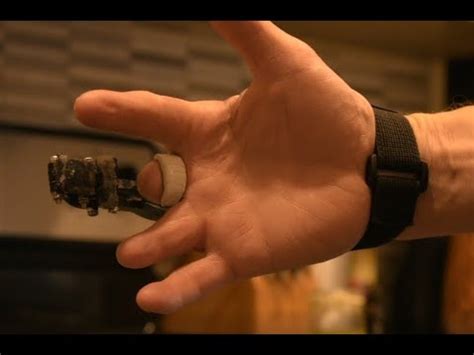 3D Printed Prosthetic Finger YouTube