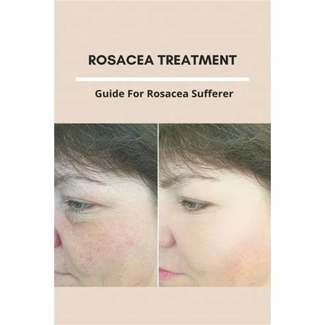 Rosacea Treatment Guide For Rosacea Sufferer Dealing With Mild